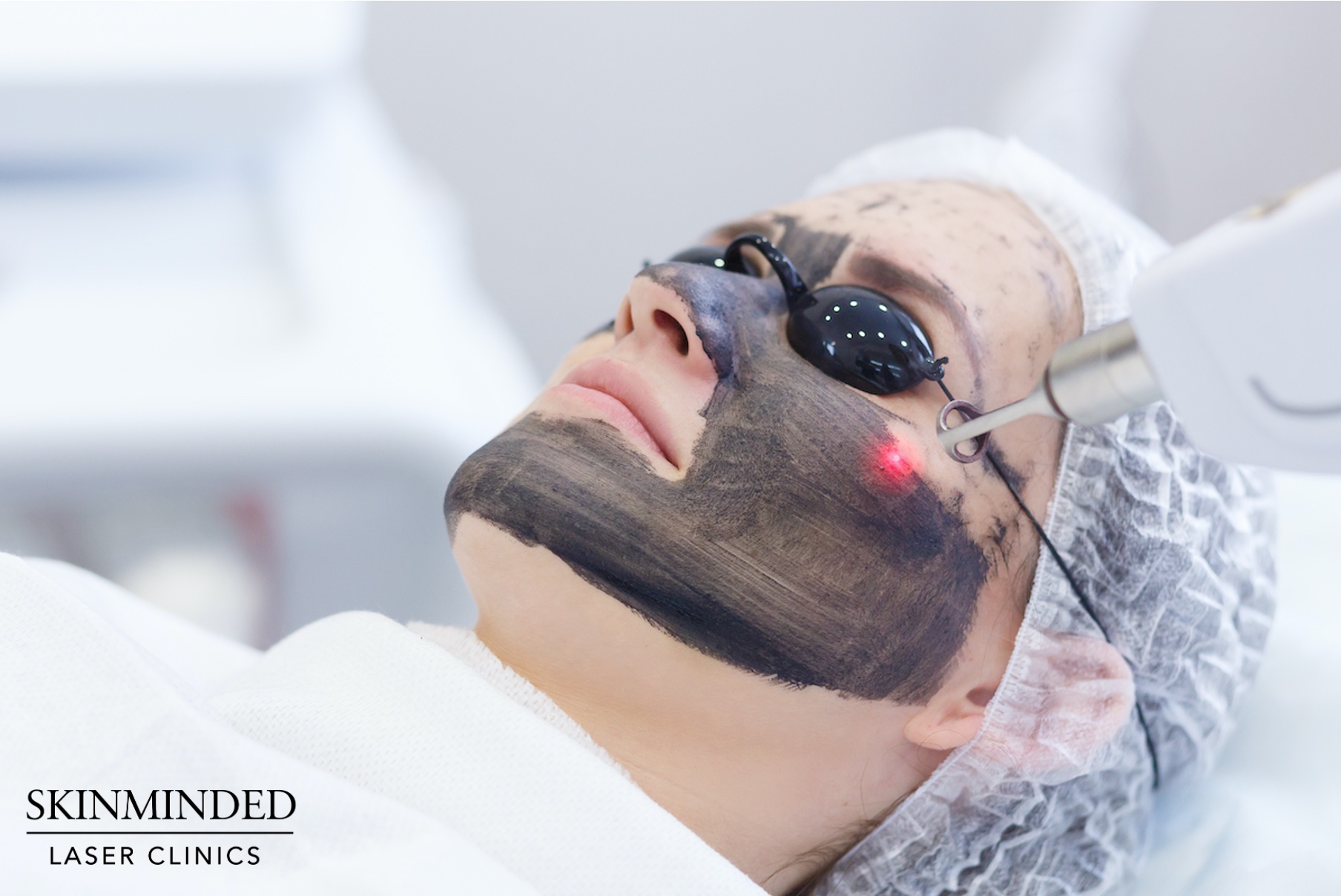 Carbon Peeling bei Skinminded