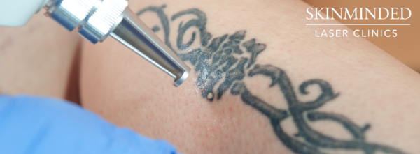 Tattooentfernung mit Nanolaser