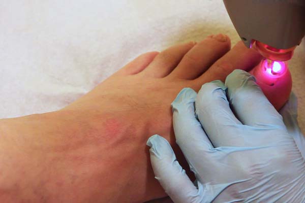 Nagelpilzentfernung mit Laser max. 3 Sitzungen