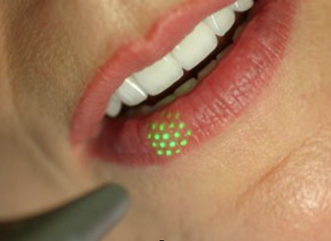 Vollere Lippen dank Laser - Skinminded Laser Clinics